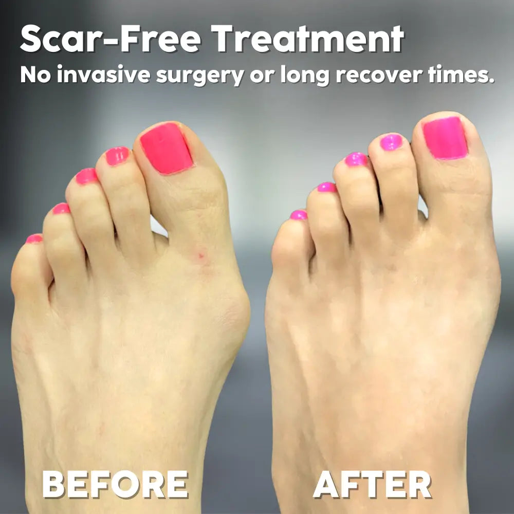 Hallux Valgus Aid — Walk Pain-Free and Confidently