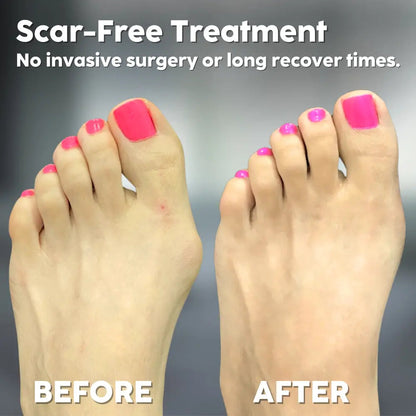 Hallux Valgus Aid — Walk Pain-Free and Confidently